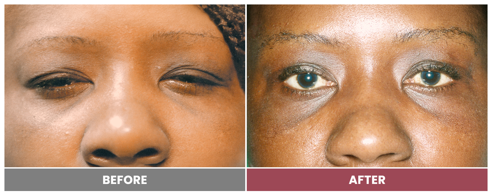 BLEPHAROPLASTY & PTOSIS REPAIR - Case 6